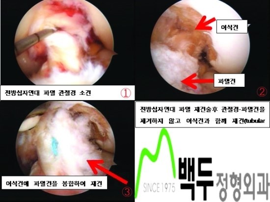 대구무릎관절 수술 추천 병원