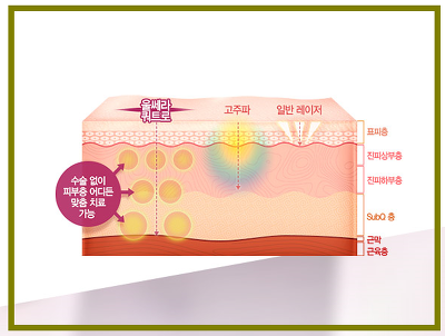 울쎄라후기 더 어려지기위한 판도라상자
